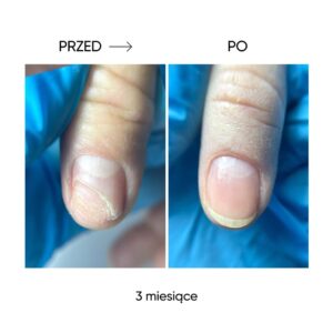 NAILSOFTHEDAY ONISTOP 8 ml – olejek regenerujący dla paznokci z onycholizą — zdjęcie 8